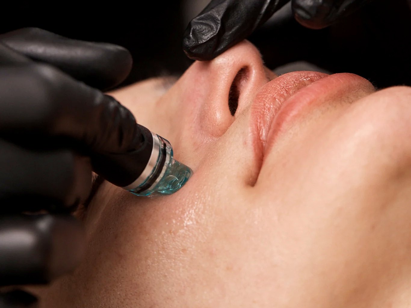 Close-up of a Hydrafacial handpiece treating the cheek at Palm Beach Cosmetic Medicine, Wellington FL