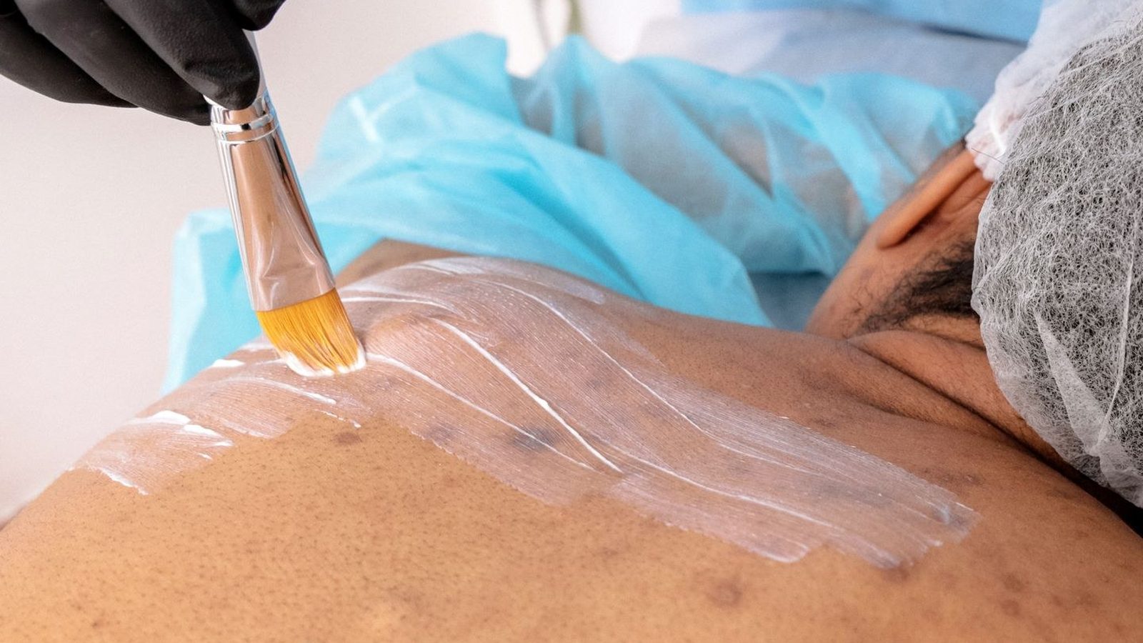Laser hair removal treatment being performed on a man's back by a clinician